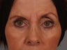 Brow Lift and Upper Blepharoplasty