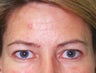 Before and After Endobrow in Female