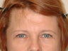 Endoscopic Brow Lift