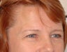 Endoscopic Brow Lift