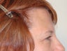 Endoscopic Brow Lift