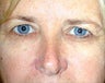 Endoscopic Brow Lift