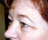 browlift and upper eyelid surgery