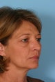 Brow Lift, Blepharoplasty, and Fat Transfer