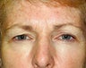 Brow Lift and Chemical Peel