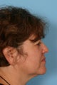 Facelift