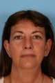 Browlift, Blepharoplasty and Otoplasty