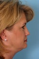 Browlift, Blepharoplasty, Lower Facelift