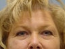 Face Lift, Brow Lift and Blepharoplasty