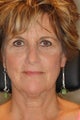 Endoscopic Brow Lift with Bilateral Upper Blepharoplasty