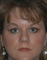 Brow Lift & Upper Eyelid Surgery