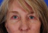 Brow Lift