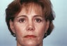 Endoscopic Brow Lift and Blepharoplasty to lower eyelid