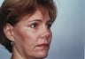 Endoscopic Brow Lift and Blepharoplasty to the lower eyelids