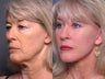 Brow lift