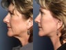 Brow Lift