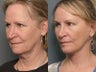 Brow Lift