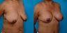 Breast lift and implants