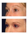 Brow lift