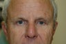 Brow Lift