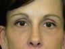 Brow Lift