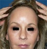 Endoscopic Browlift