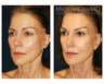 Brow lift & Fat Transfer