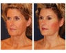Facial Rejuvenation