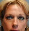 Brow Lift