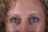 Endoscopic browlift, upper and lower blepharoplasty (eyelids)