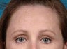 Brow Lift