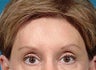Brow Lift