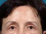 Brow Lift