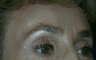 forehead lift