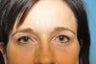 Blepharoplasty and Forehead Lift