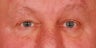 Endoscopic Browlift