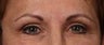 Brow rejuvenation