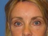 Browlift & Lower Blepharoplasty