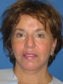 Open Browlift, Facelift, Upper & Lower Blepharoplasty