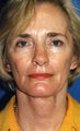 Browlift