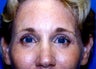 Brow Lift with Blepharoplasty