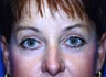 Brow Lift with Blepharoplasty