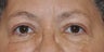 Browlift