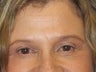Brow Lift
