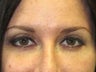 Brow Lift 