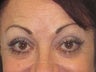 Brow Lift