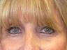 Brow Lift