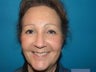 Endoscopic brow lift, upper and lore blepharoplasty, mid face lift and septal reset