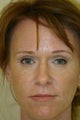 Brow Lift