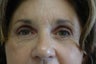 Forehead and Brow lift